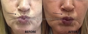 Anti Wrinkle Injections - 8