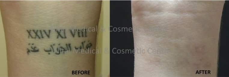 Laser Tattoo Removal - 2