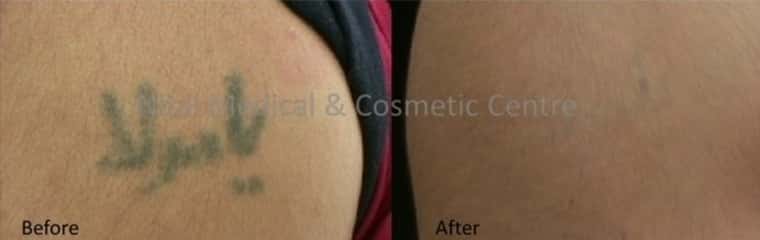 Laser Tattoo Removal - 3
