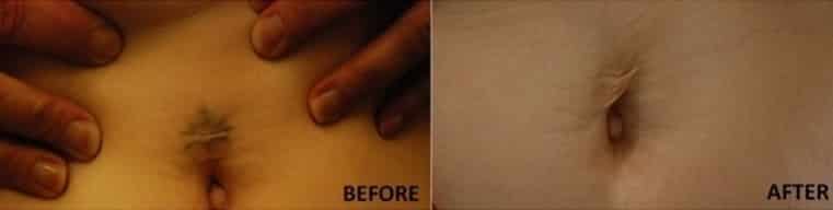 Laser Tattoo Removal - 4