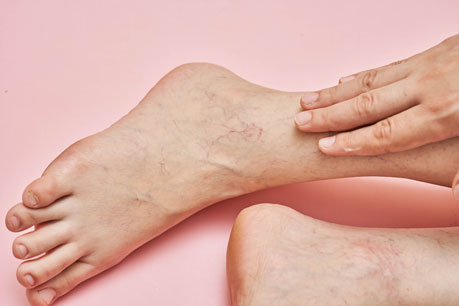How to get rid of Spider Veins - 1
