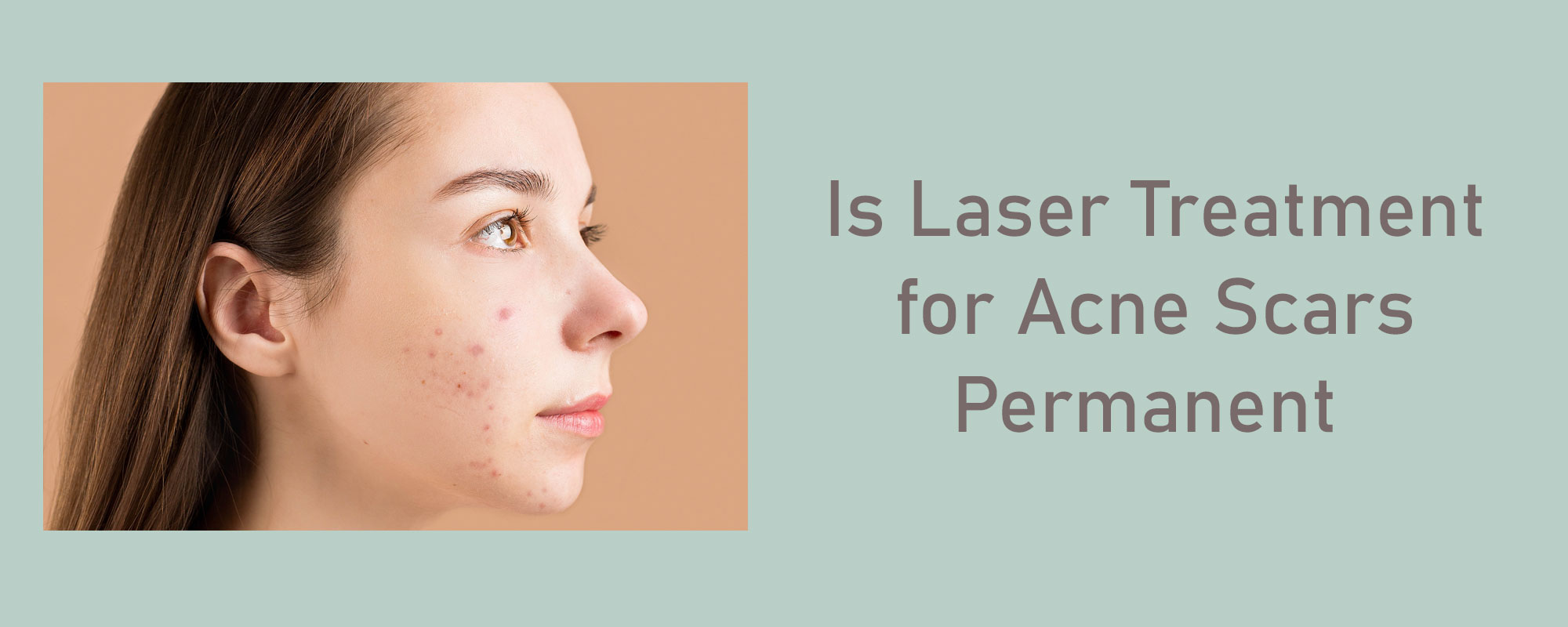Is Laser Treatment for Acne Scars Permanent? - 1