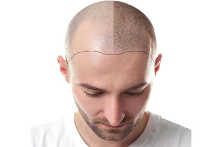 FUE Hair transplant Recovery: What to Expect - 1