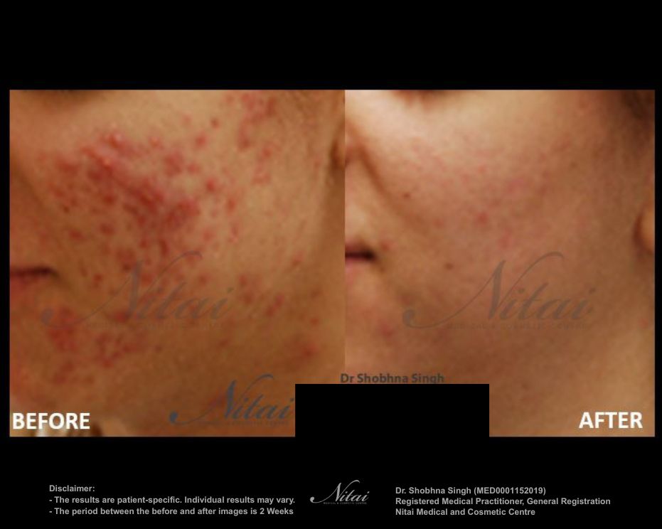 Acne Scarring Treatment BA Image