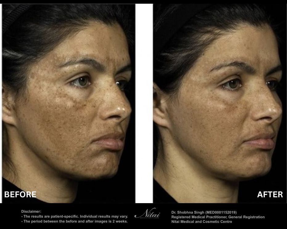 Fraxel treatment for Melasma, before and after 02-2