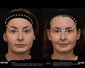 Anti-Wrinkle Treatment BA Image