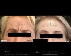 Anti-Wrinkle Treatment BA Image