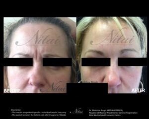 Anti-Wrinkle Treatment BA Image