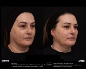 Anti-Wrinkle Treatment BA Image