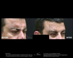 Anti-Wrinkle Treatment BA Image