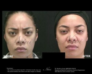 Anti-Wrinkle Treatment BA Image