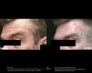 Anti-Wrinkle Treatment BA Image
