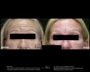 Anti-Wrinkle Treatment BA Image