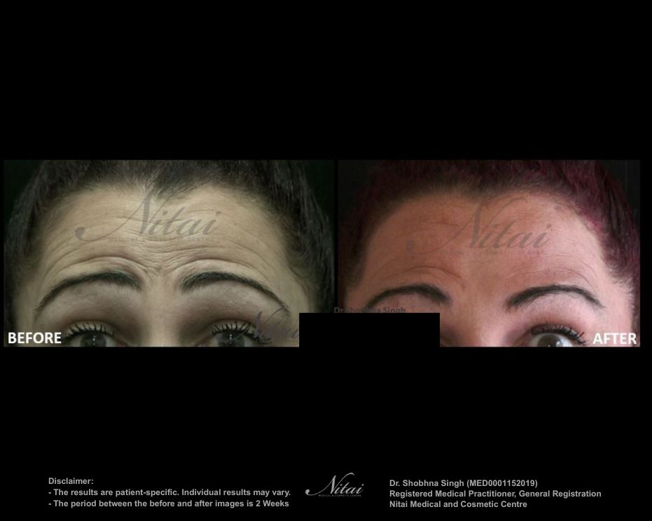 Forehead Wrinkle Lines