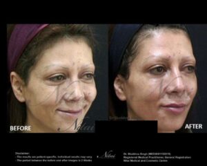 Anti-Wrinkle Treatment BA Image