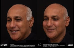 Anti-Wrinkle Treatment BA Image