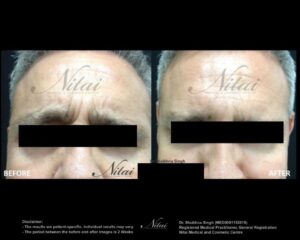 Anti-Wrinkle Treatment BA Image