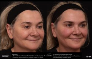 Anti-Wrinkle Treatment BA Image