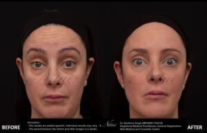 Anti-Wrinkle Treatment BA Iamge