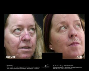 Dermal Treatment BA Image