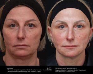 Cheek Volume Treatment BA Image