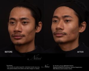 Cheek Volume Treatment BA Image