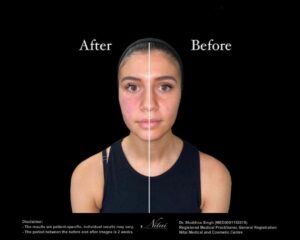 Cheek Volume Treatment BA Image