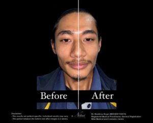 Cheek Volume Treatment BA Image