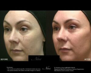 Cheek Volume Treatment BA Image