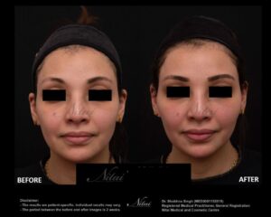 Cheek Volume Treatment BA Image