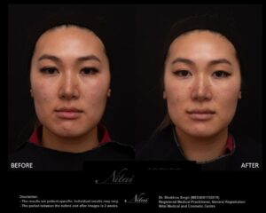 Cheek Volume Treatment BA Image