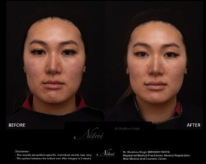Cheek Volume Treatment BA Image