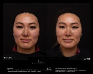 Cheek Volume Treatment BA Image