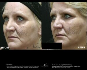 Cheek Volume Treatment BA Image