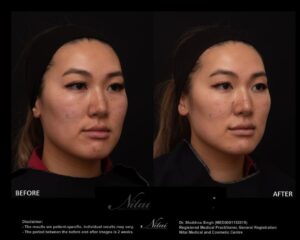 Cheek Volume Treatment BA Image