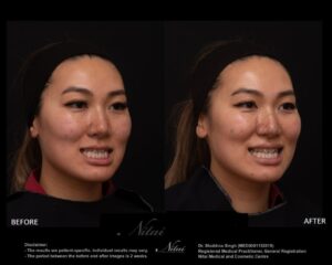 Cheek Volume Treatment BA Image