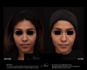 Cheek Volume Treatment BA Image