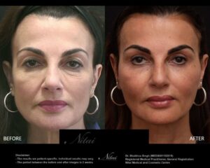 Cheek Volume Treatment BA Image