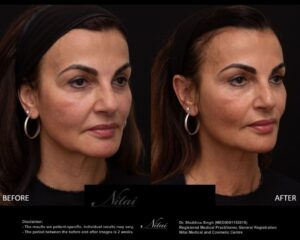 Cheek Volume Treatment BA Image