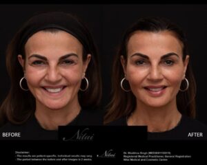 Cheek Volume Treatment BA Image