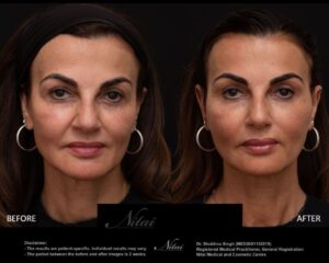 Cheek Volume Treatment BA Image