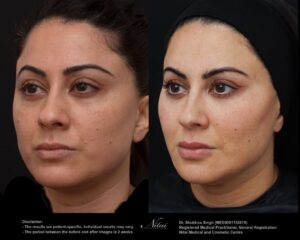 Cheek Volume Treatment BA Image