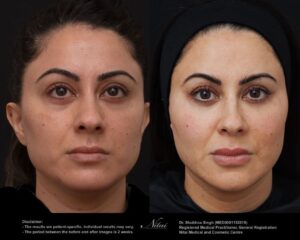 Cheek Volume Treatment BA Image