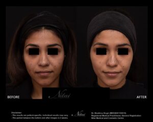 Cheek Volume Treatment BA Image