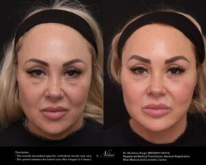 Cheek Volume Treatment BA Image