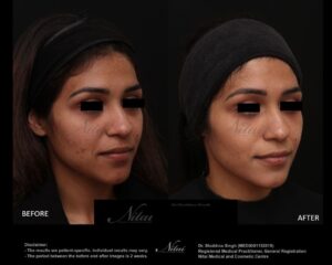 Cheek Volume Treatment BA Image