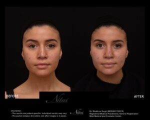 Cheek Volume Treatment BA Image