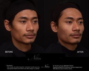 Cheek Volume Treatment BA Image