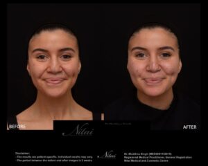 Cheek Volume Treatment BA Image