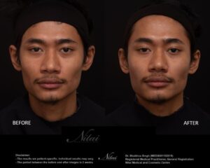 Cheek Volume Treatment BA Image